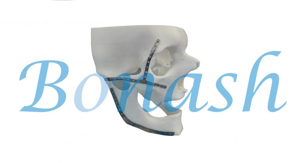 Custom Made Titanium Plates Bonash Medical Patient Specific Implants