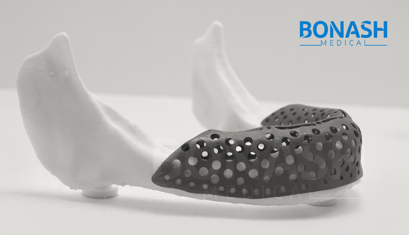3D Printed Implant Bonash Medical Patient Specific Implants