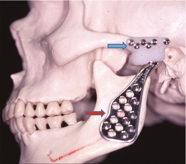در تعویض مفصل، ایمپلنت تیتانیومی فک پایین را به قاعده جمجمه متصل می‌کند